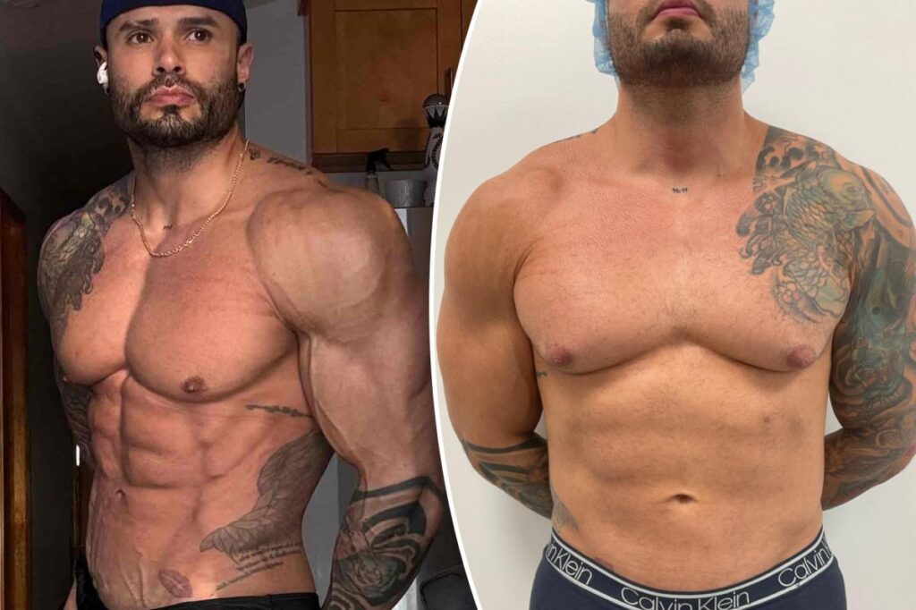 I took steroids for a decade — here’s what it did to my nipples