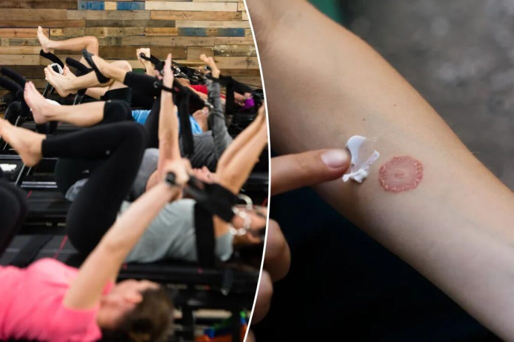 -per-class fitness studio is leaving people with ringworm: reports
